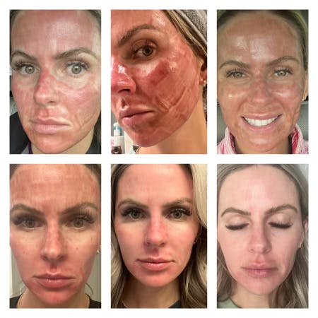Laser Skin Resufacing Before & After Gallery - Patient 350953 - Image 1