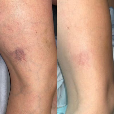 Laser Skin Resufacing Before & After Gallery - Patient 252639 - Image 1