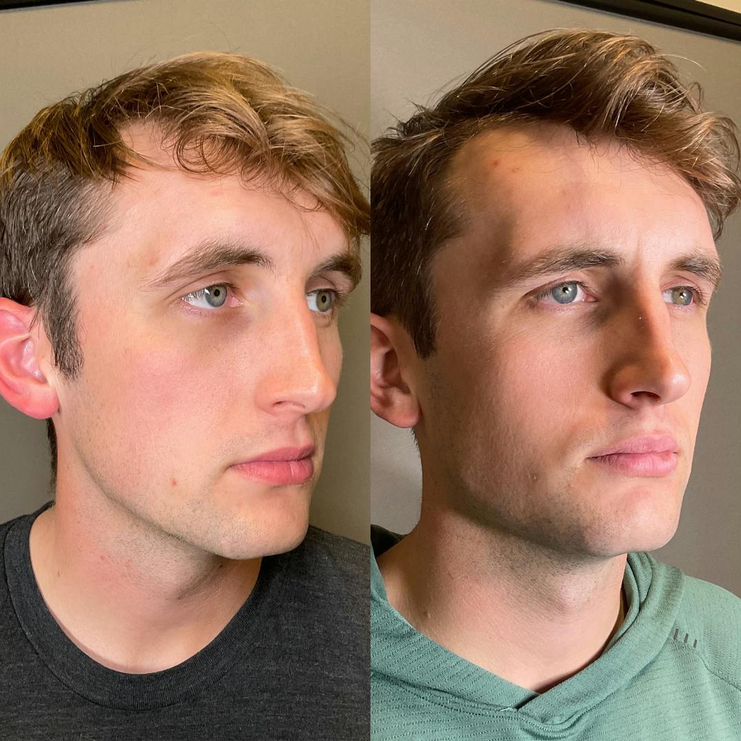 Jawline Contouring  Before & After Gallery - Patient 235511 - Image 1