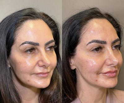 Facial Rejuvenation (Facial Balancing)  Before & After Gallery - Patient 137531 - Image 1