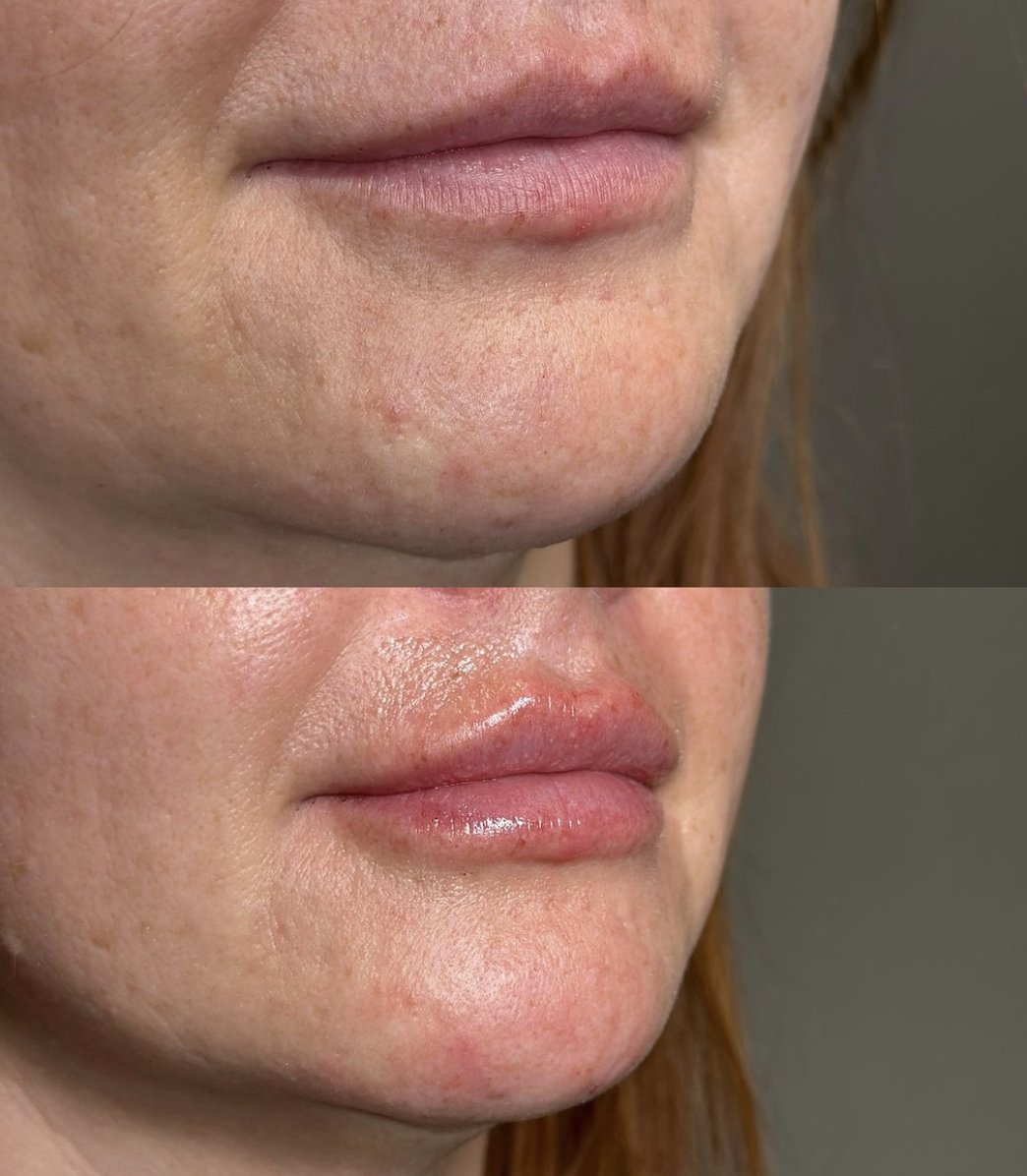RHA Fillers Before & After Gallery - Patient 343192 - Image 1