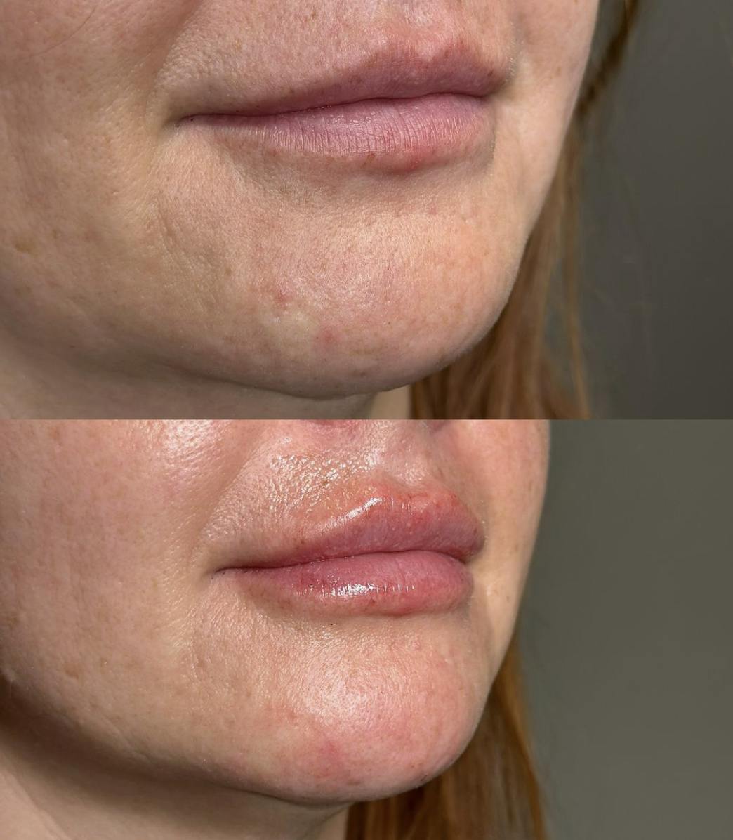 RHA Fillers Before & After Gallery - Patient 343192 - Image 1
