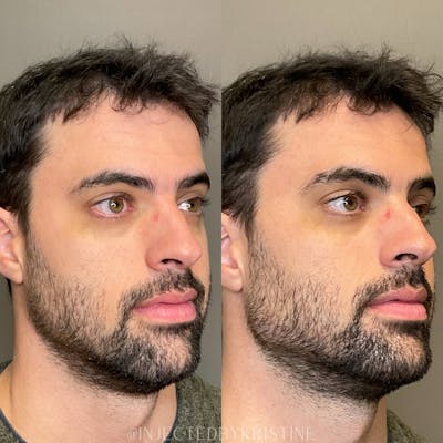 Jawline Contouring  Before & After Gallery - Patient 594253 - Image 1