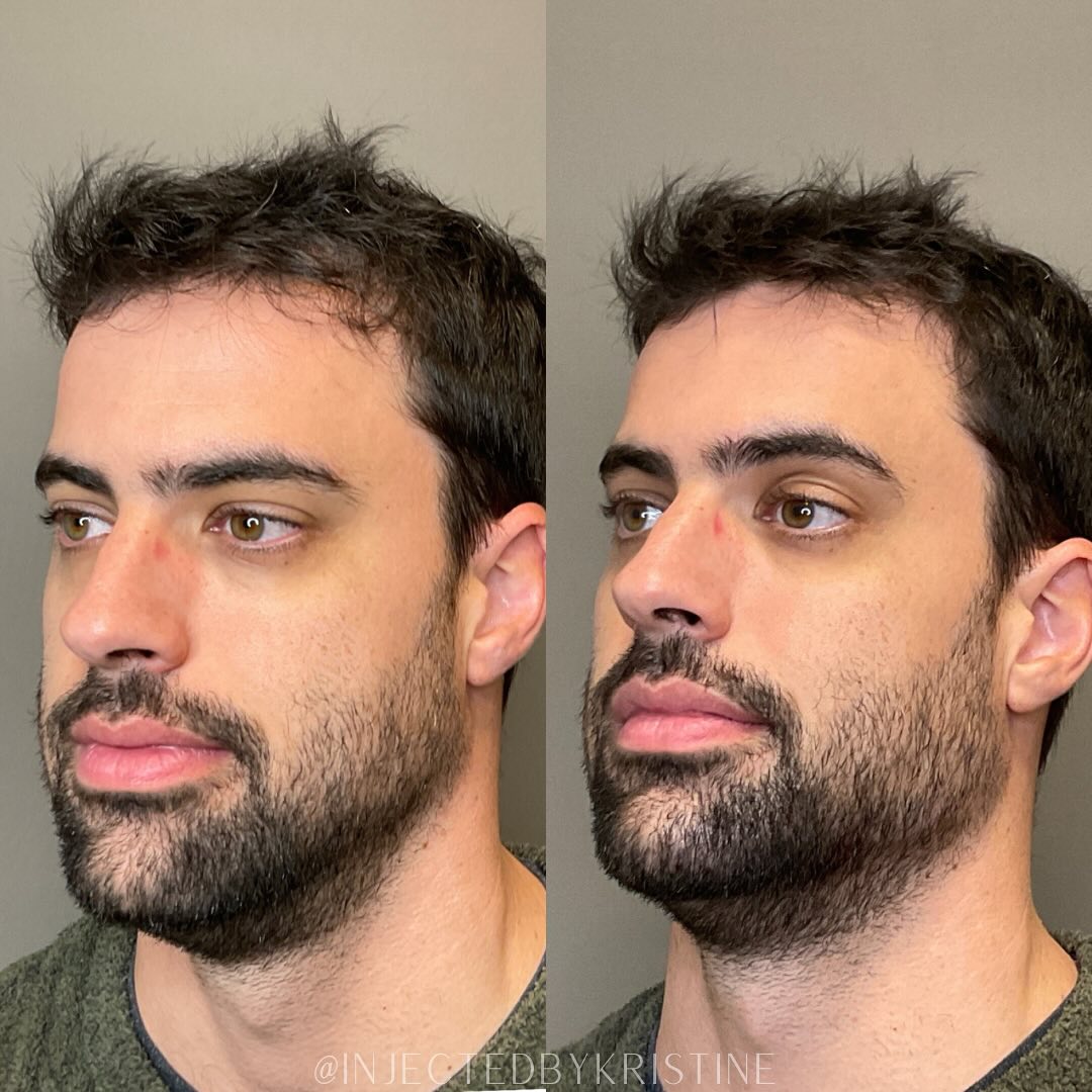 Jawline Contouring  Before & After Gallery - Patient 594253 - Image 3