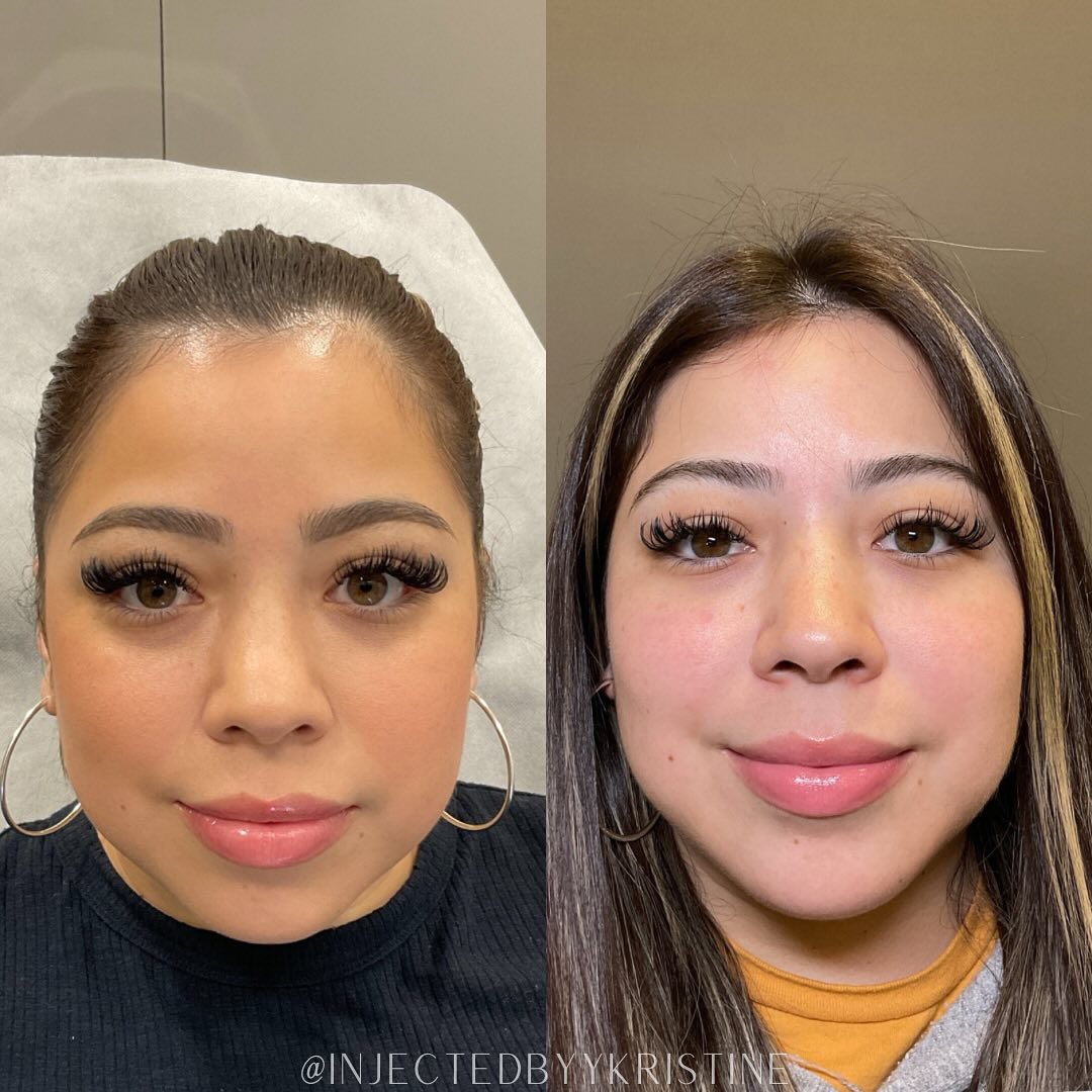 Facial Rejuvenation (Facial Balancing)  Before & After Gallery - Patient 390782 - Image 1