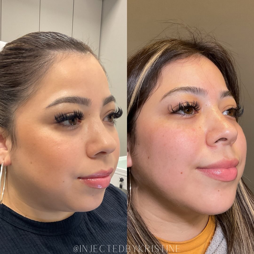 Facial Rejuvenation (Facial Balancing)  Before & After Gallery - Patient 390782 - Image 2