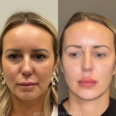 Facial Rejuvenation (Facial Balancing)  Before & After Gallery - Patient 391678 - Image 1