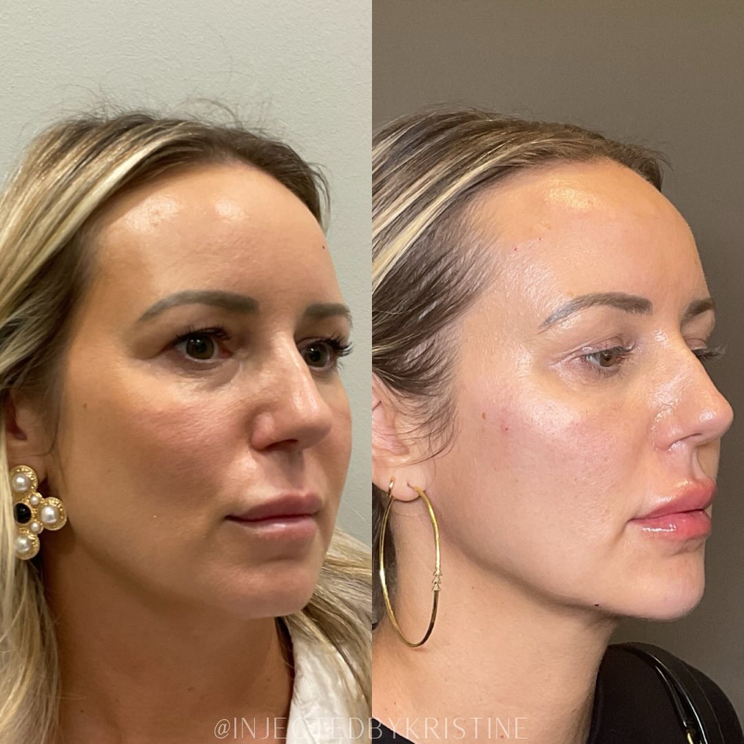 Facial Rejuvenation (Facial Balancing)  Before & After Gallery - Patient 391678 - Image 2
