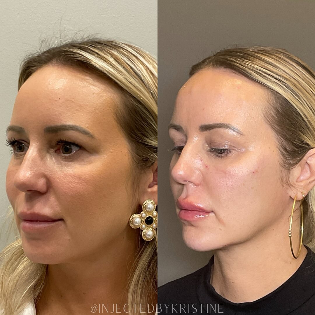 Facial Rejuvenation (Facial Balancing)  Before & After Gallery - Patient 391678 - Image 3