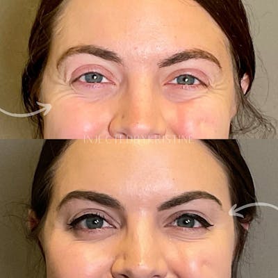 BOTOX Before & After Gallery - Patient 153897 - Image 1