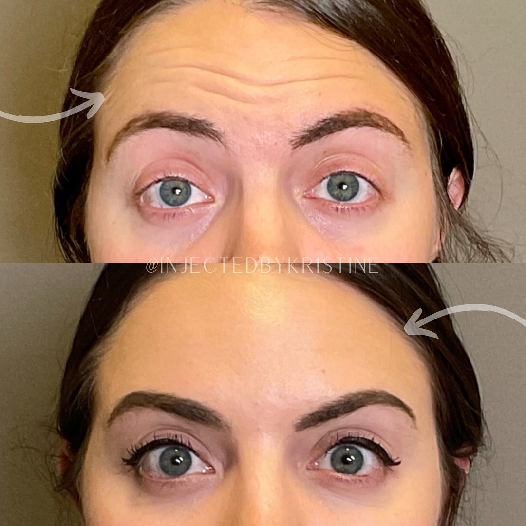 BOTOX Before & After Gallery - Patient 153897 - Image 2