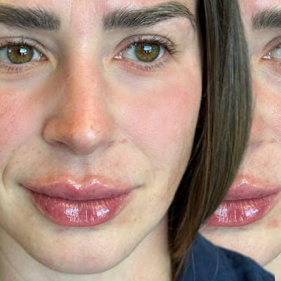 Lip Fillers Before & After Gallery - Patient 398064 - Image 1
