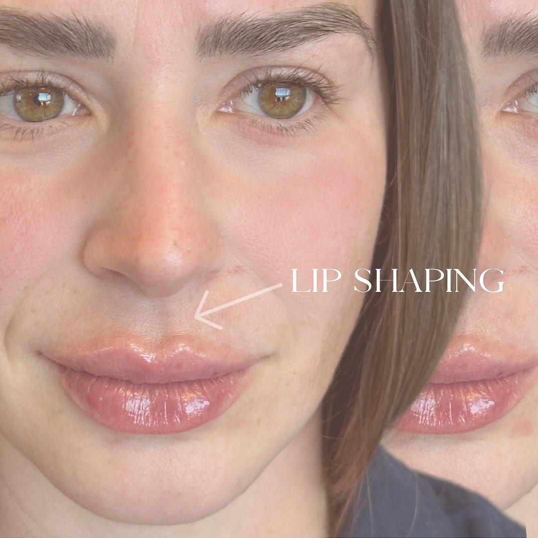 Lip Fillers Before & After Gallery - Patient 398064 - Image 2