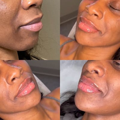Lip Fillers Before & After Gallery - Patient 700547 - Image 1