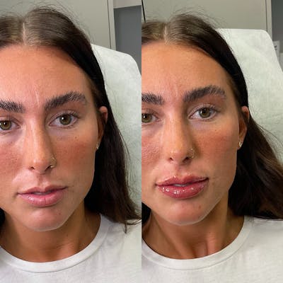 Lip Fillers Before & After Gallery - Patient 178378 - Image 1