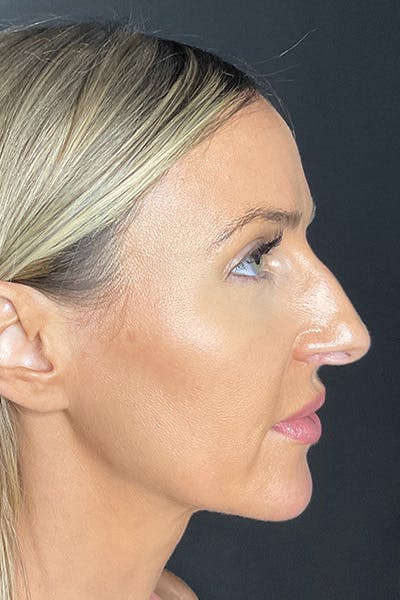 Rhinoplasty Before & After Gallery - Patient 283647 - Image 1