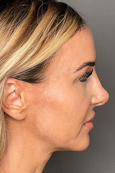 Rhinoplasty Before & After Gallery - Patient 283647 - Image 2