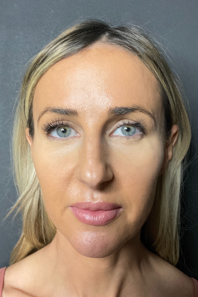 Rhinoplasty Before & After Gallery - Patient 283647 - Image 3