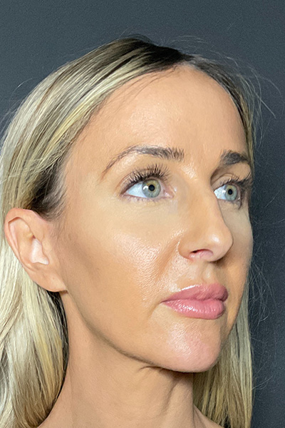 Rhinoplasty Before & After Gallery - Patient 283647 - Image 5