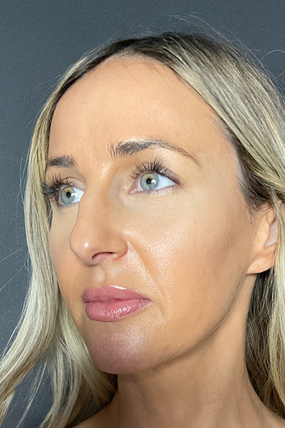 Rhinoplasty Before & After Gallery - Patient 283647 - Image 7