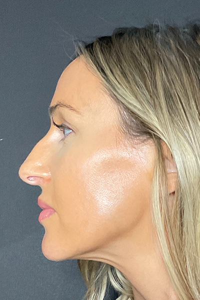 Rhinoplasty Before & After Gallery - Patient 283647 - Image 9