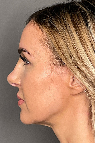 Rhinoplasty Before & After Gallery - Patient 283647 - Image 10