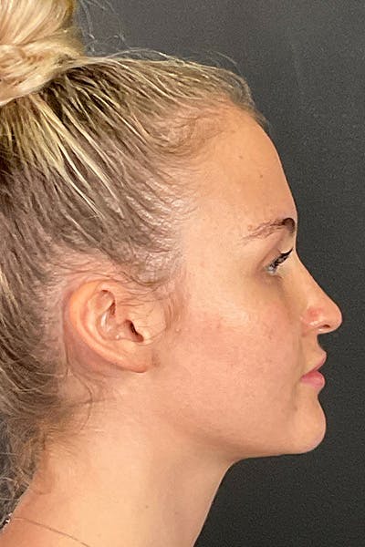 Rhinoplasty Before & After Gallery - Patient 106713 - Image 1