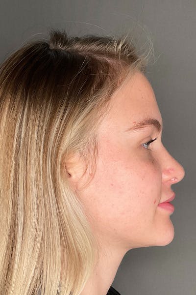 Rhinoplasty Before & After Gallery - Patient 106713 - Image 2