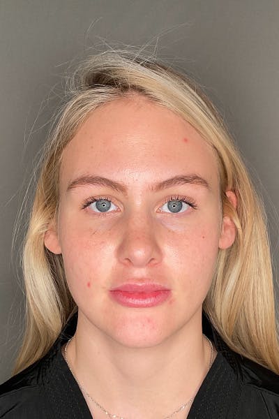 Rhinoplasty Before & After Gallery - Patient 106713 - Image 4