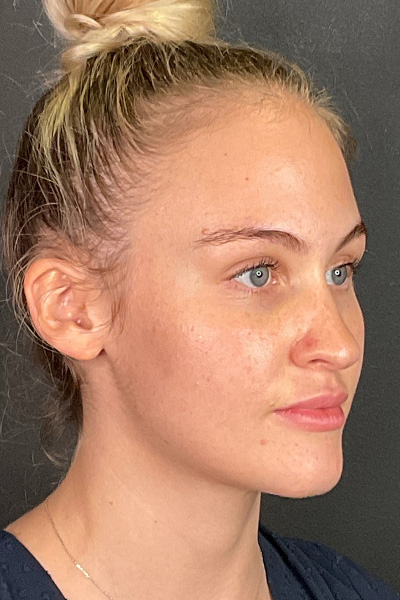 Rhinoplasty Before & After Gallery - Patient 106713 - Image 5