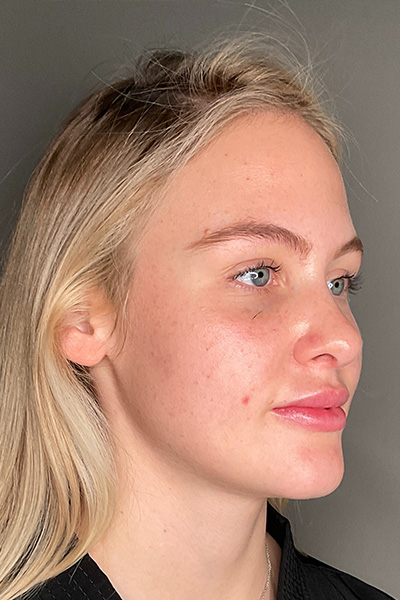 Rhinoplasty Before & After Gallery - Patient 106713 - Image 6
