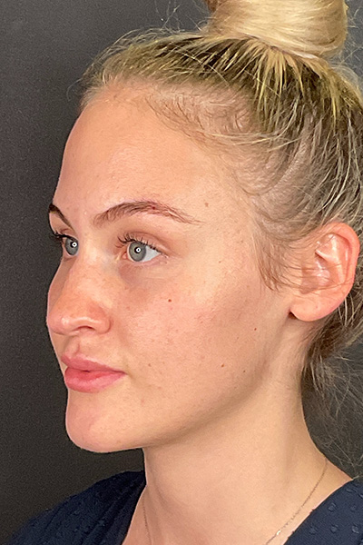Rhinoplasty Before & After Gallery - Patient 106713 - Image 7