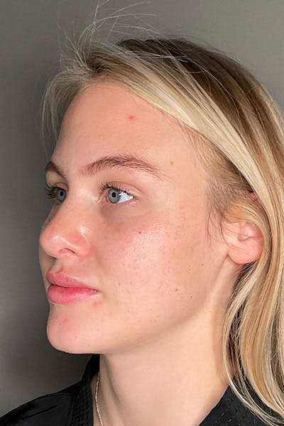 Rhinoplasty Before & After Gallery - Patient 106713 - Image 8