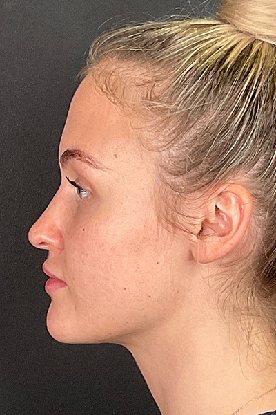 Rhinoplasty Before & After Gallery - Patient 106713 - Image 9