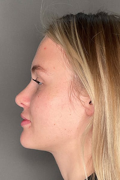Rhinoplasty Before & After Gallery - Patient 106713 - Image 10