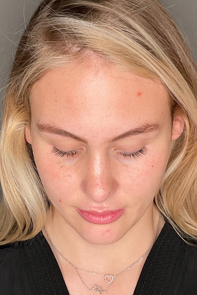 Rhinoplasty Before & After Gallery - Patient 106713 - Image 12