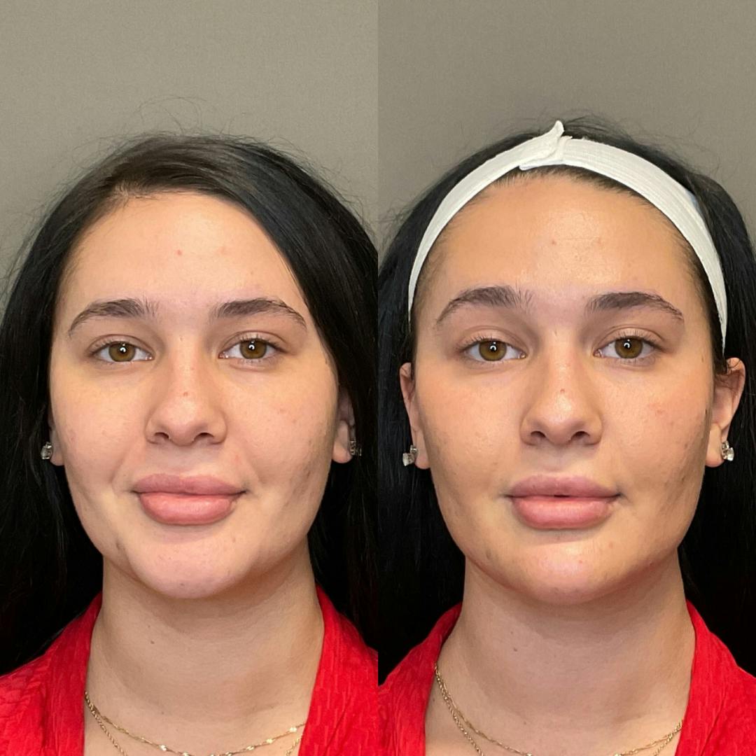 Facial Rejuvenation (Facial Balancing)  Before & After Gallery - Patient 357514 - Image 1