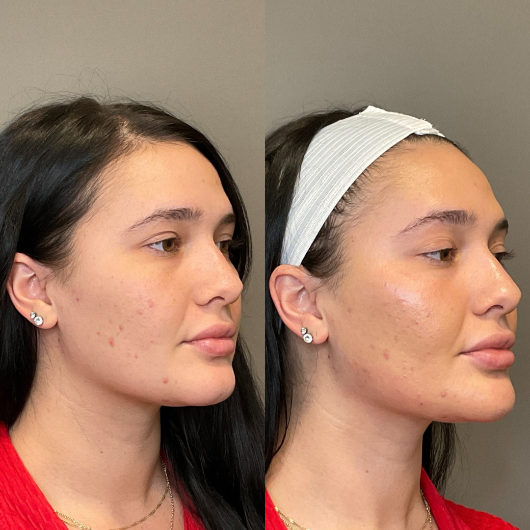 Facial Rejuvenation (Facial Balancing)  Before & After Gallery - Patient 357514 - Image 2