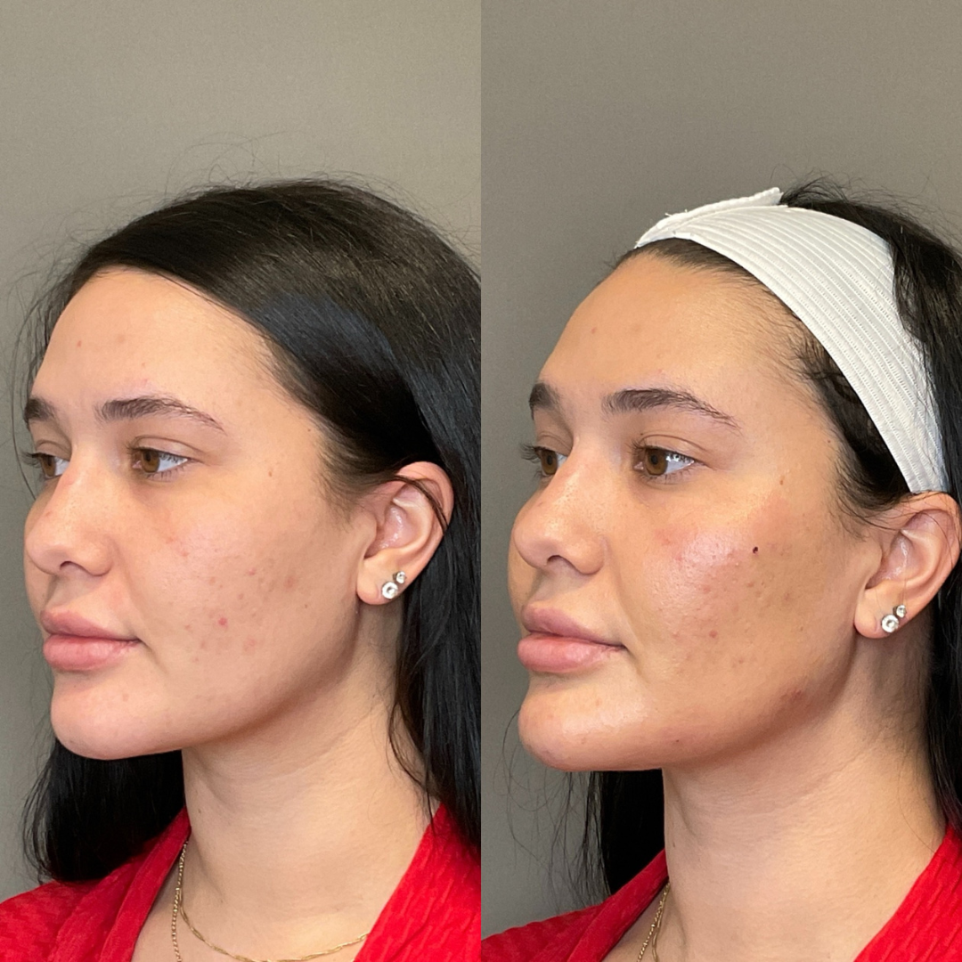 Facial Rejuvenation (Facial Balancing)  Before & After Gallery - Patient 357514 - Image 3