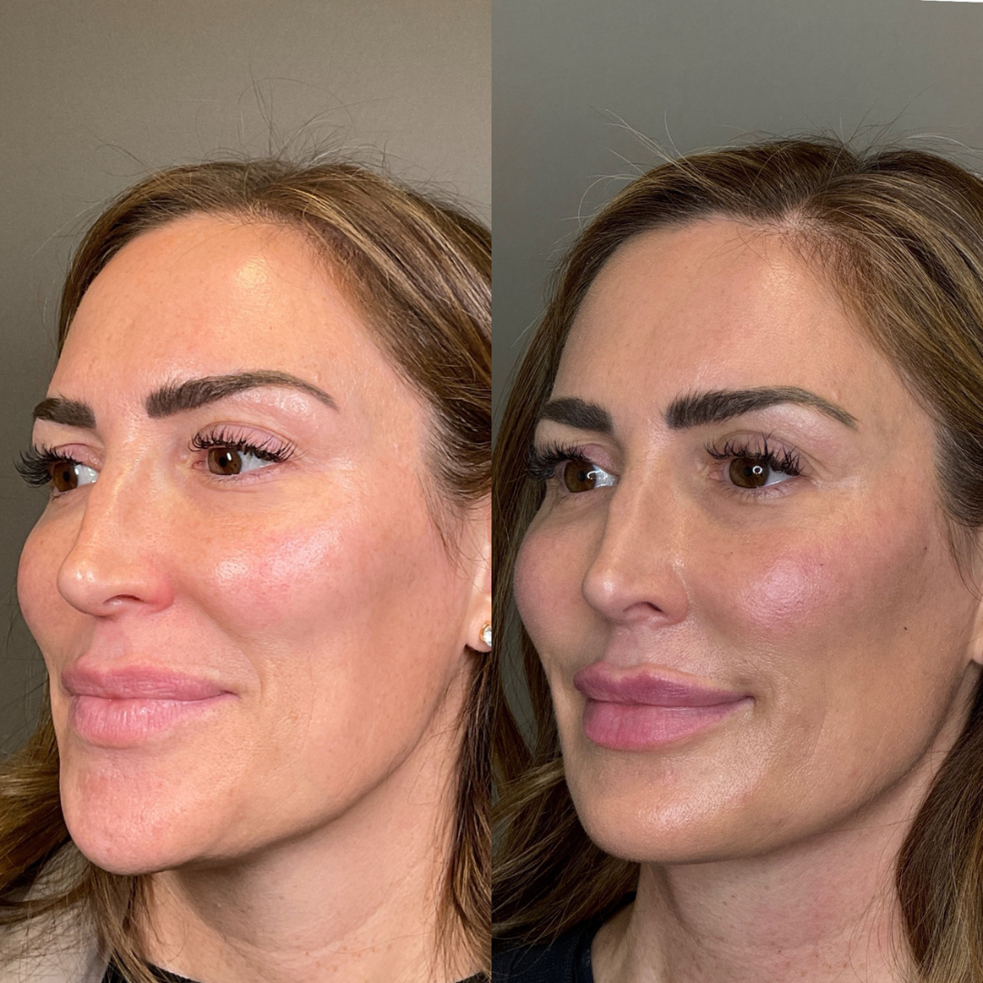 Lip Fillers Before & After Gallery - Patient 360721 - Image 2