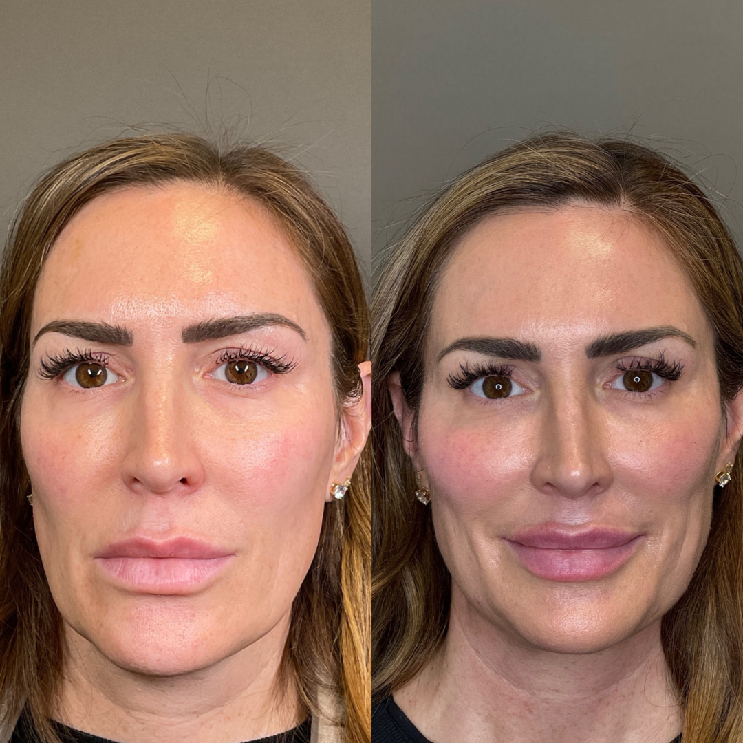 Lip Threads Before & After Gallery - Patient 323655 - Image 1