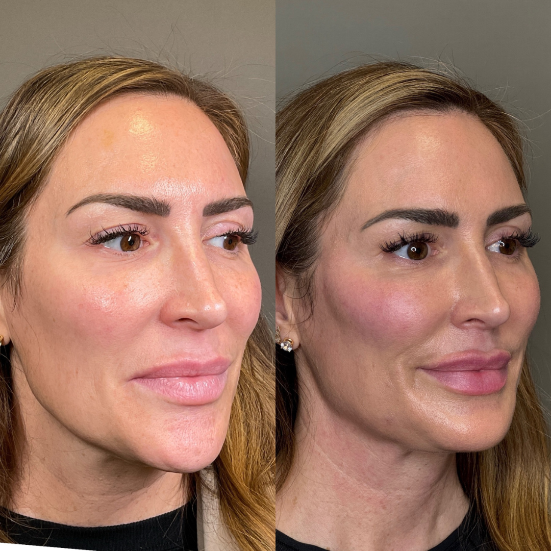 Lip Fillers Before & After Gallery - Patient 360721 - Image 3