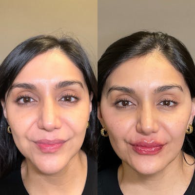 Facial Rejuvenation (Facial Balancing)  Before & After Gallery - Patient 246810 - Image 1
