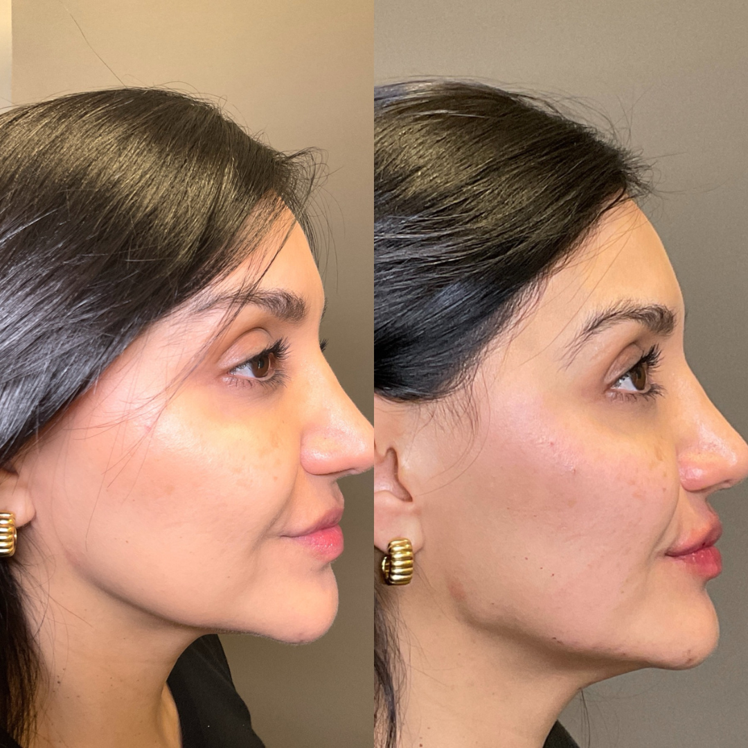 Facial Rejuvenation (Facial Balancing)  Before & After Gallery - Patient 246810 - Image 2
