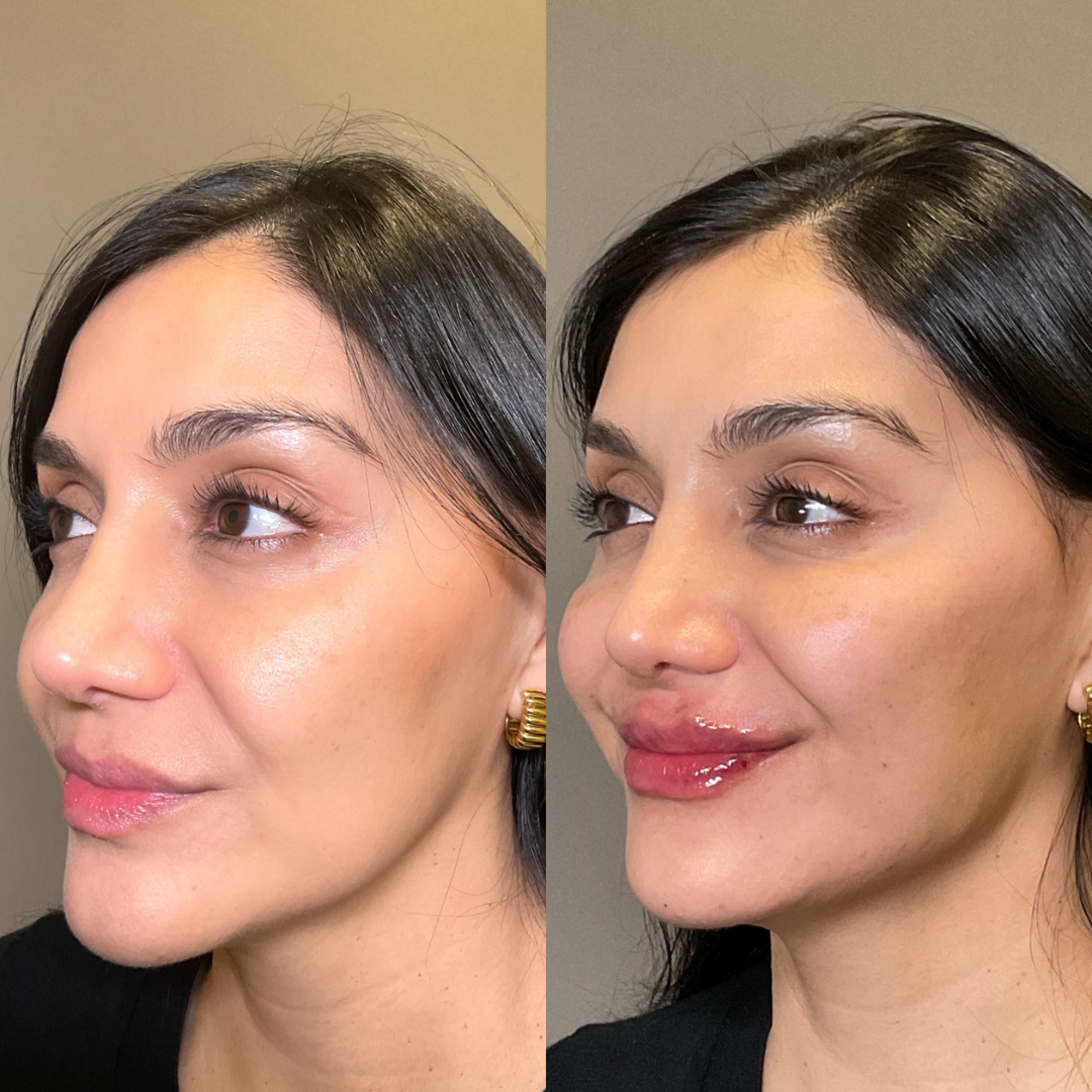 Sculptra Before & After Gallery - Patient 221916 - Image 3