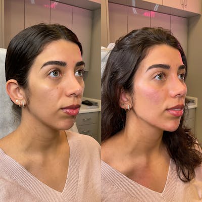 Facial Rejuvenation (Facial Balancing)  Before & After Gallery - Patient 419751 - Image 1