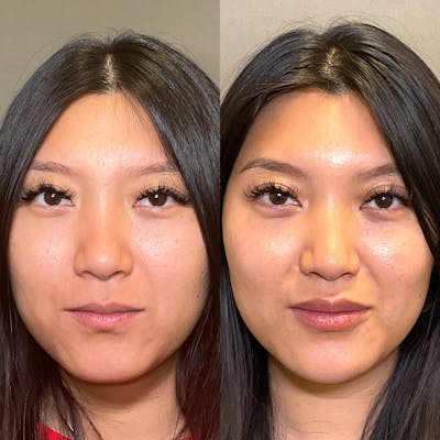 Lip Fillers Before & After Gallery - Patient 384150 - Image 1