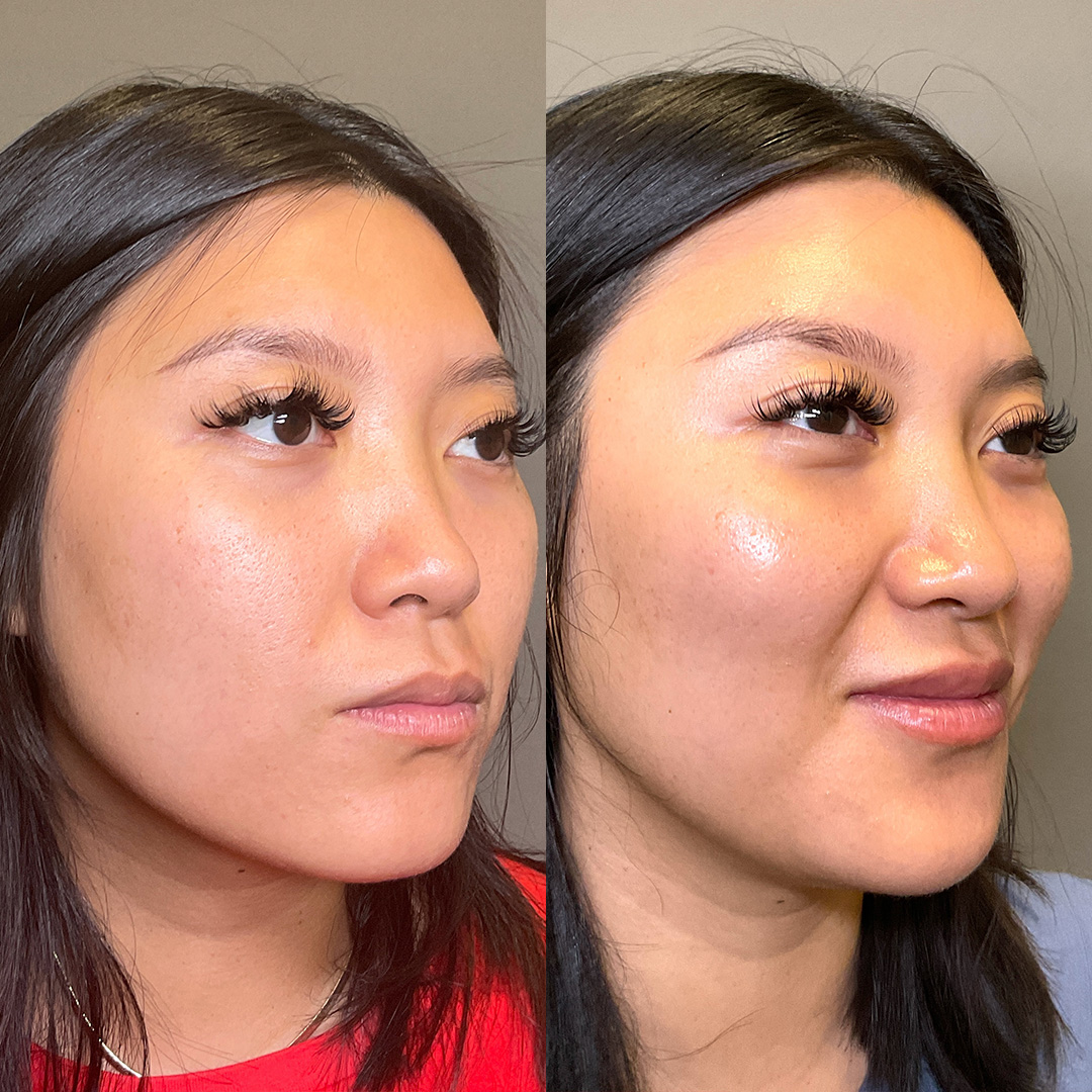 Lip Fillers Before & After Gallery - Patient 384150 - Image 2