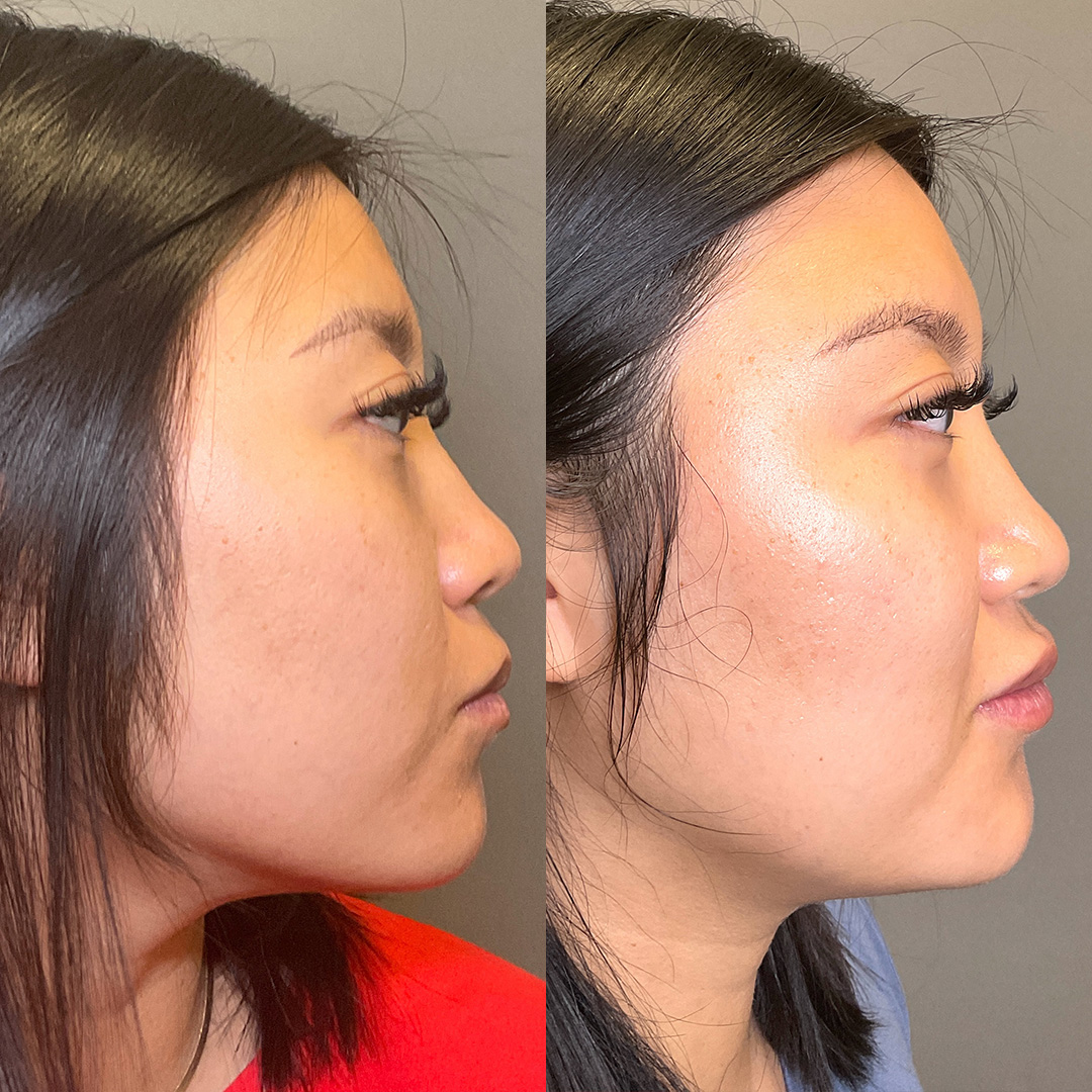 Chin Before & After Gallery - Patient 126462 - Image 3
