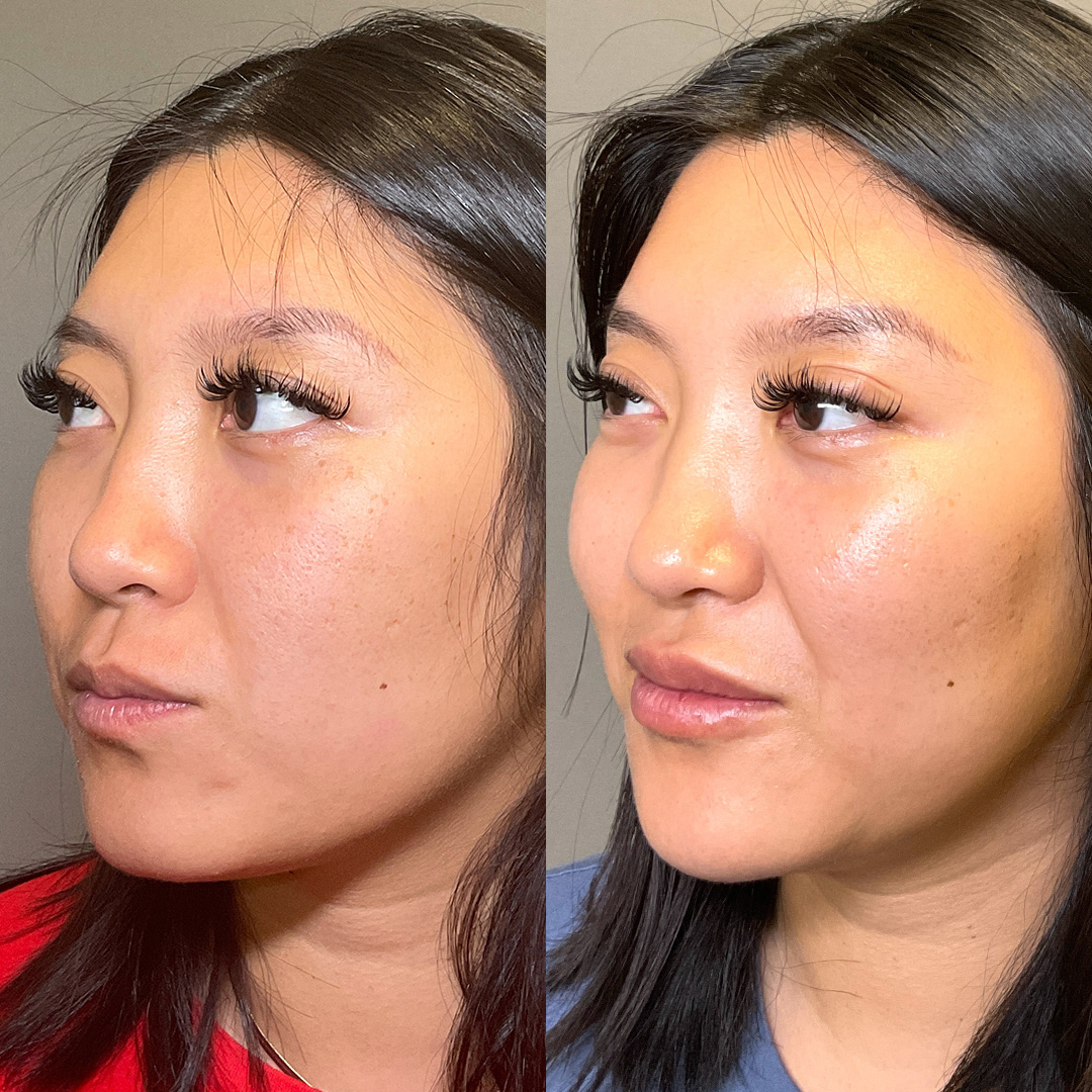 Lip Fillers Before & After Gallery - Patient 384150 - Image 4